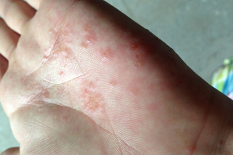 手部湿疹手掌有水疱图
