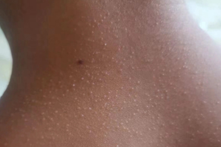 光泽苔藓后颈好多丘疹图