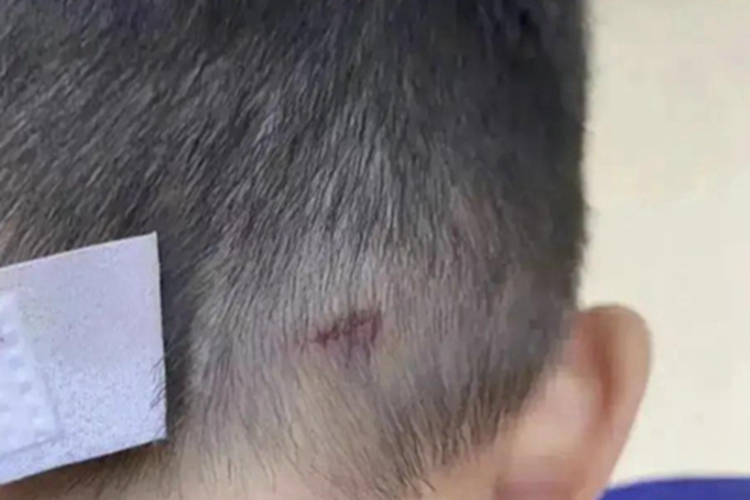 戳伤头部血痂图 戳伤头部血痂图