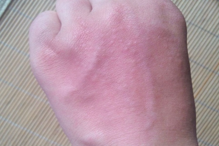 昆虫性皮炎手部肿图