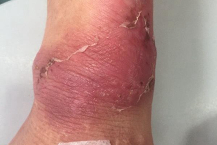 急性发热性嗜中性皮病脱皮图