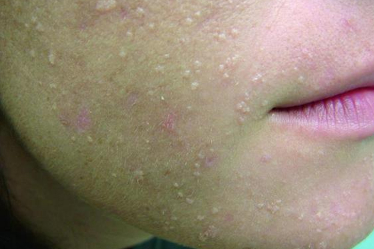 艾滋病面部扁平疣图