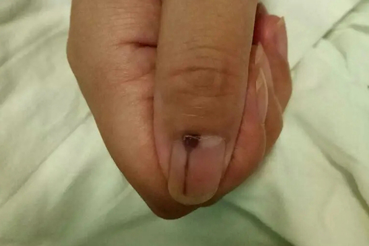 药物不良反应指甲下线状出血图