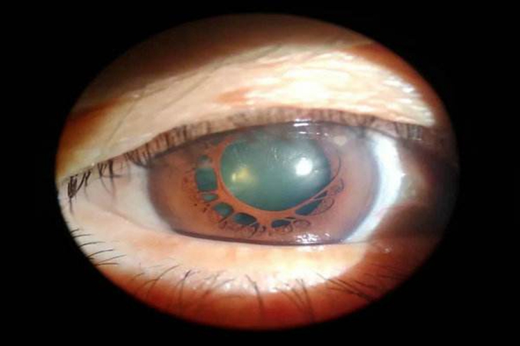 瞳孔残膜图