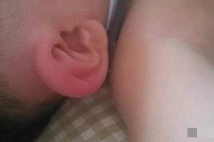 虫咬皮炎耳廓红肿图