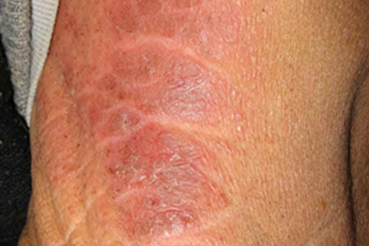 干性湿疹肋部大片红斑图