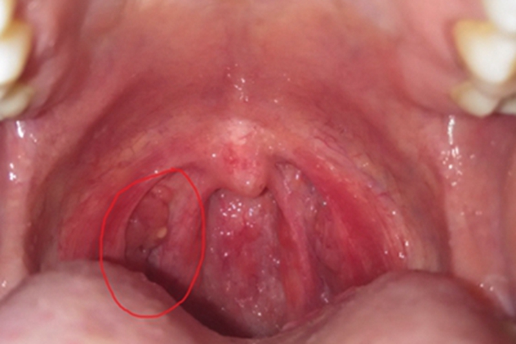 扁桃体结石症状图