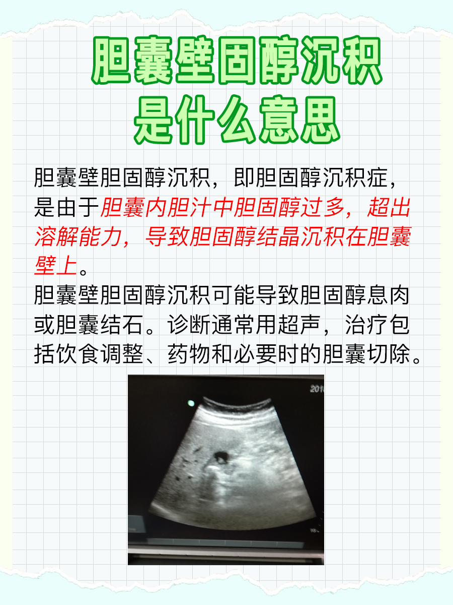 胆囊壁固醇沉积探索:你的胆囊健康吗?