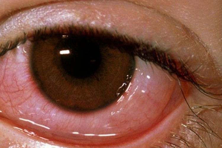 急性结膜炎患者的结膜水肿图