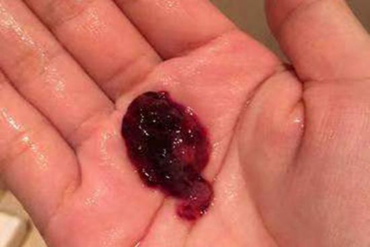 生化妊娠物排出物图 生化妊娠物排出物图