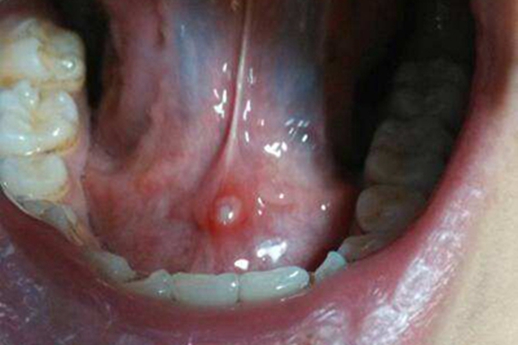 舌癌舌根处有一个疱疹图 舌癌舌根处有一个疱疹图