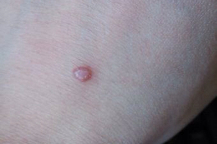 良性幼年黑色瘤丘疹图