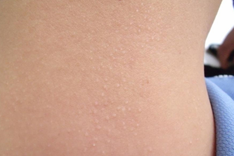 光泽苔藓后颈丘疹图 光泽苔藓后颈丘疹图