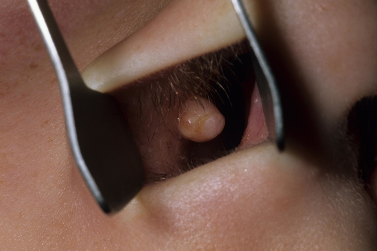 鼻息肉鼻腔有结节图