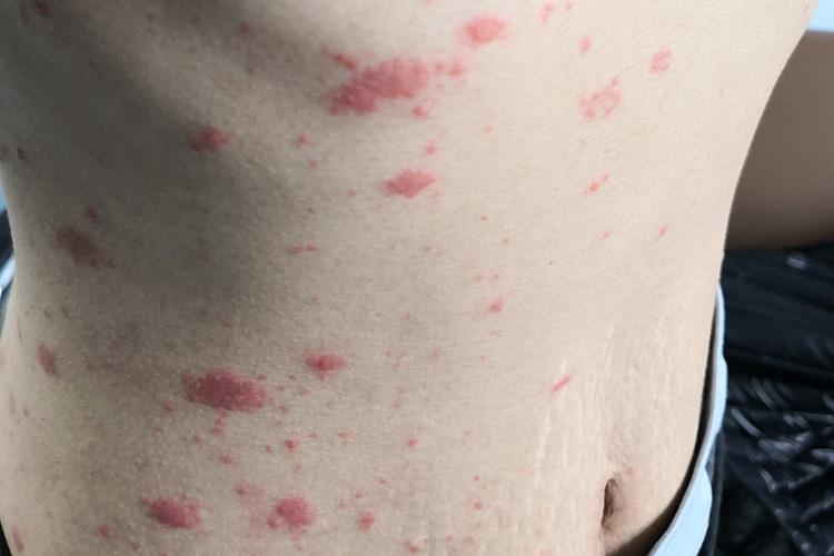 玫瑰糠疹圆形红斑图