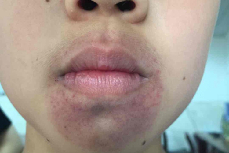 机械性紫癜口周斑图 机械性紫癜口周斑图