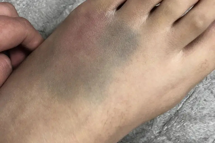 外伤左脚脚背疼位置图