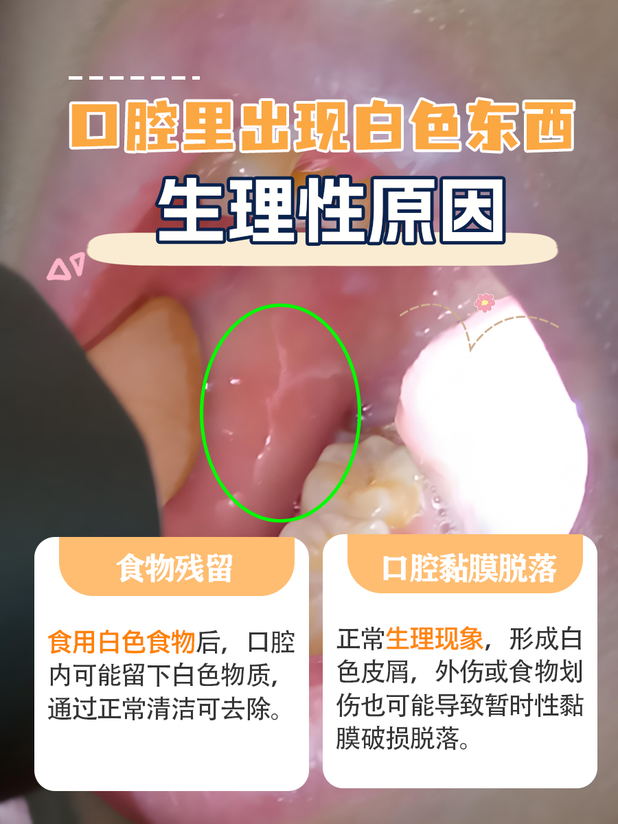 口腔里出现白色东西，究竟是什么？快来一探究竟