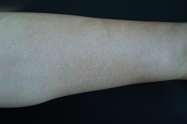 老年性点状白斑小腿长圆形白点图