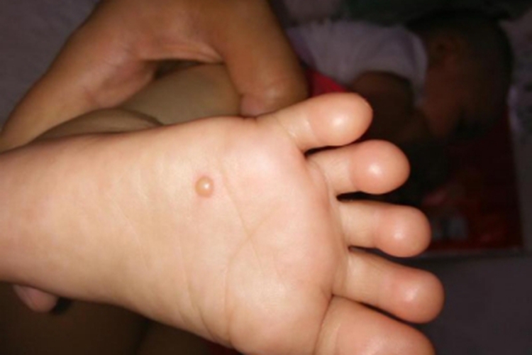 婴儿肢端脓疱病脚底症状图