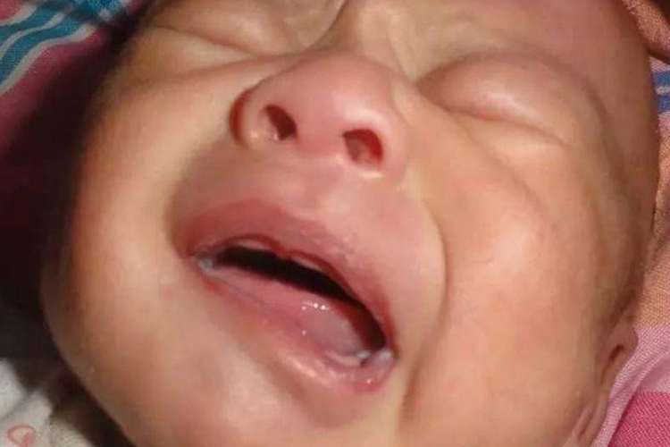 歪嘴哭综合征图