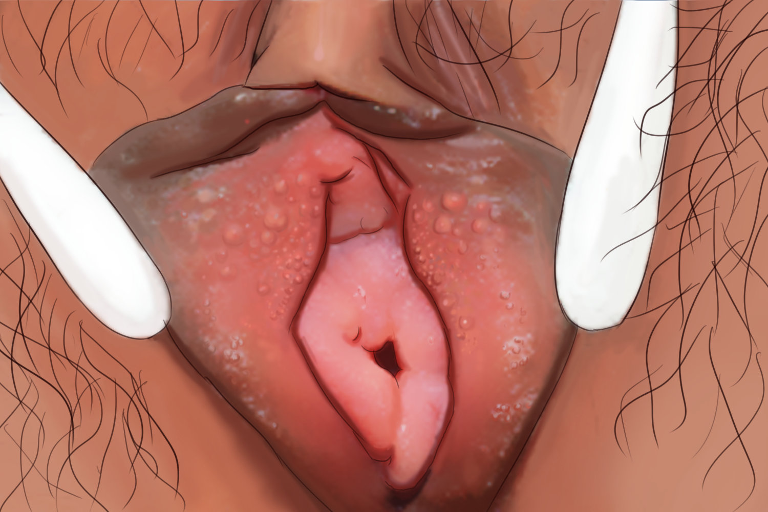 假性湿疣疙瘩手绘图 假性湿疣疙瘩手绘图