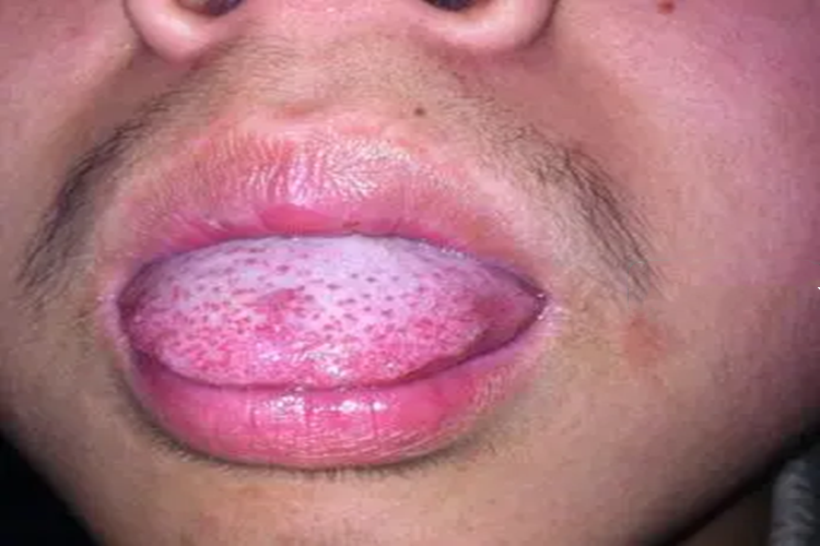 其他舌乳头炎均以充血,红肿,疼痛为主要临床表现,如菌状乳头炎舌乳头