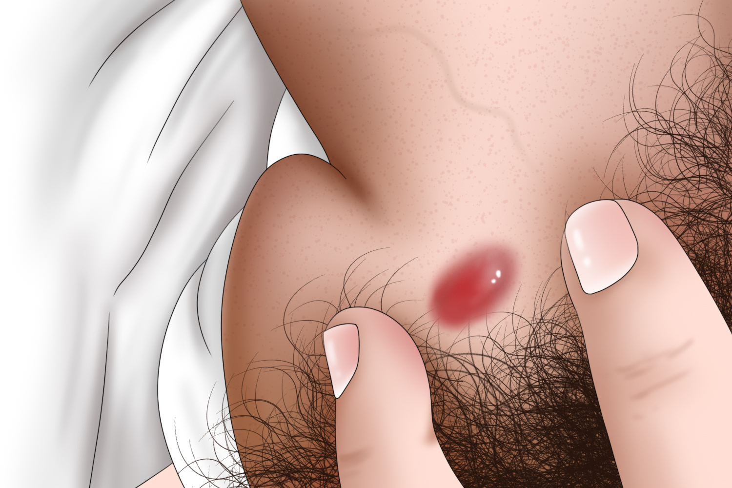 皮脂腺囊肿阴茎红肿手绘图 皮脂腺囊肿阴茎红肿手绘图