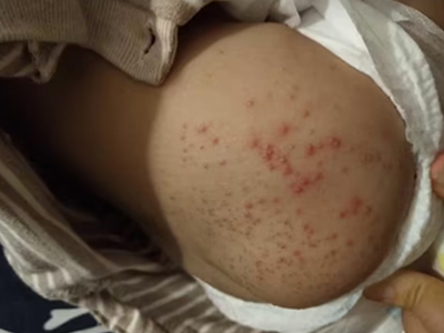 新生儿红斑屁股上有凸起的小红疙瘩图.jpg