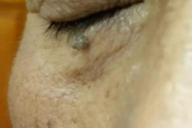 恶性雀斑痣样黑素瘤眼周症状图