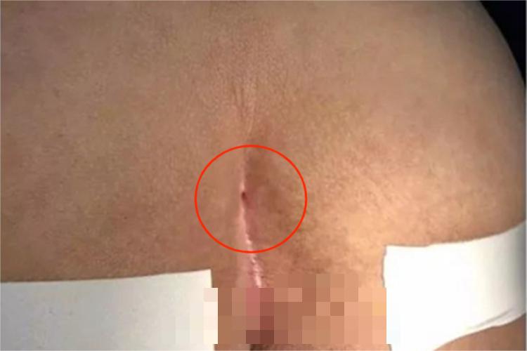 骶尾部藏毛窦小坑图 骶尾部藏毛窦小坑图