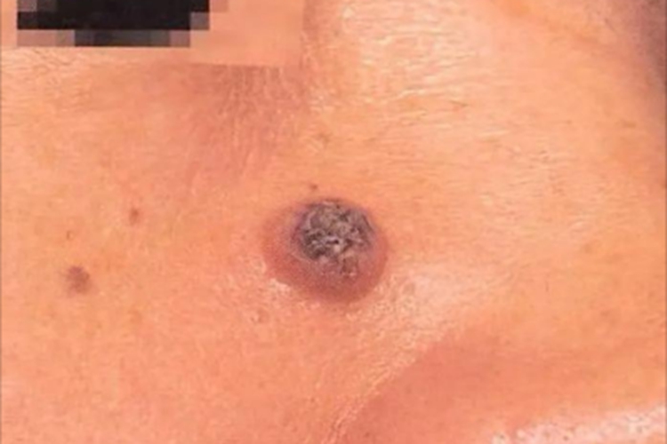 角化棘皮瘤结节图