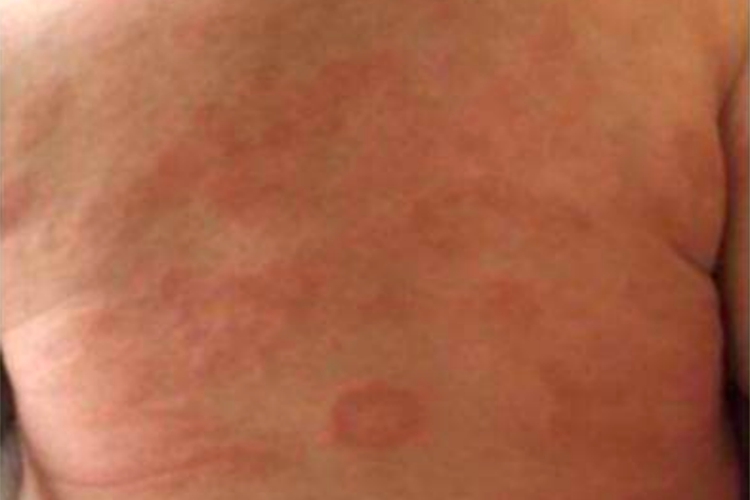 婴儿期后背特应性皮炎图