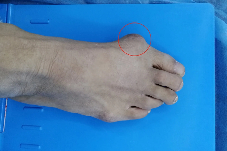 右脚拇外翻内侧疼痛部位图