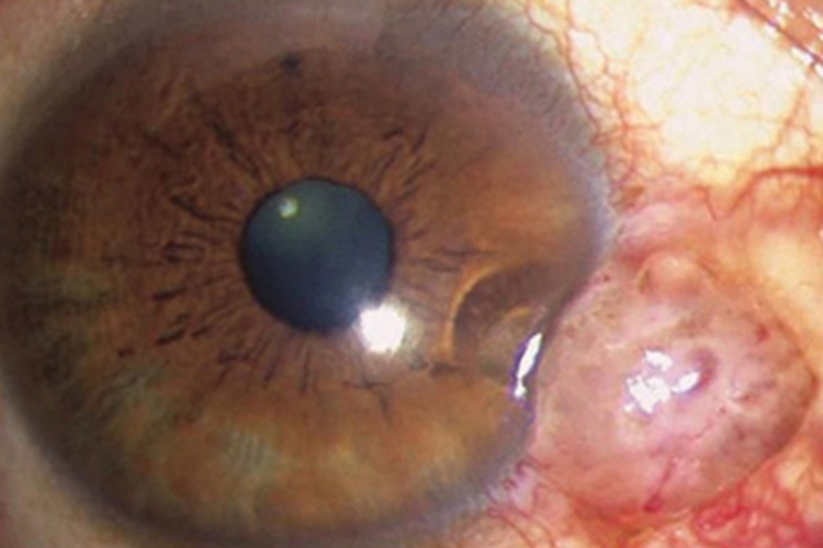 角膜鳞状上皮细胞癌眼球疙瘩图