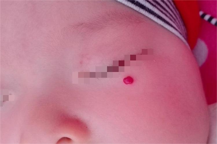 血管瘤眼周小红疙瘩图