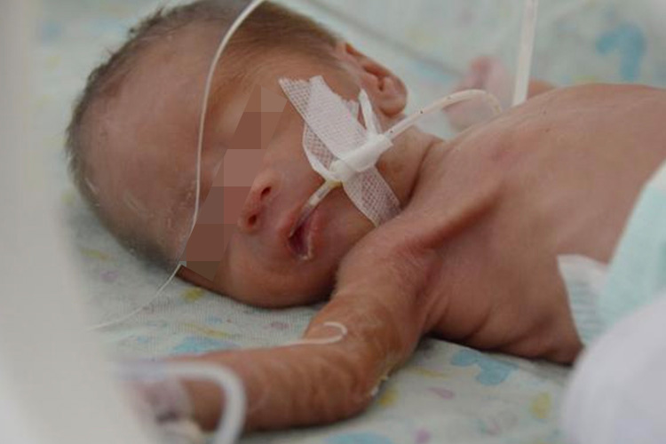 婴儿吸气三凹征图