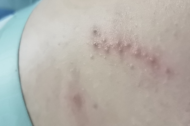 带状疱疹腰部有一串小水疱图