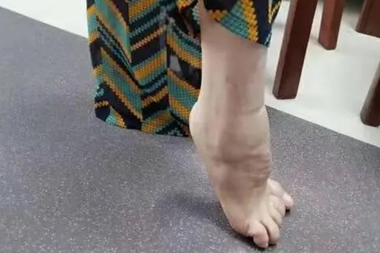 马蹄足图