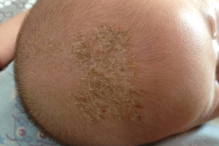 2个月宝宝脂性鳞屑图 2个月宝宝脂性鳞屑图