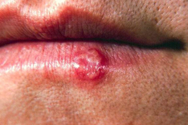 口腔单纯性疱疹嘴唇水疱图