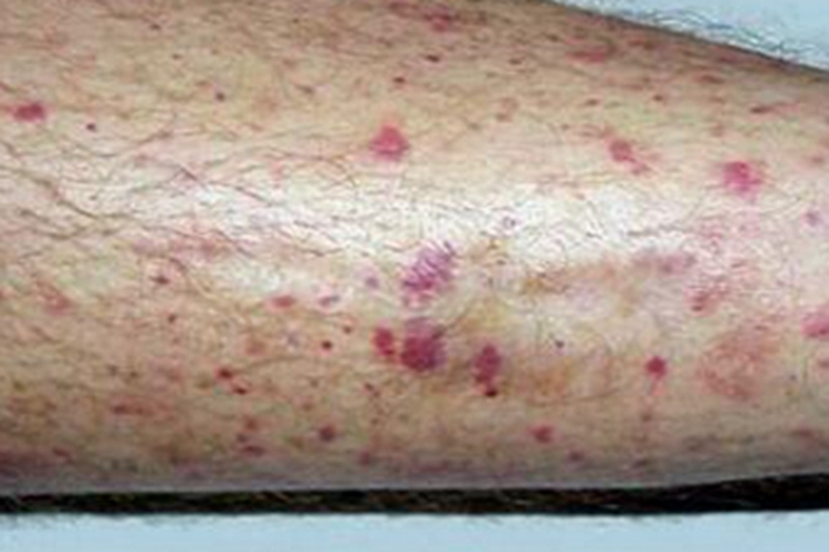 冷球蛋白血症小腿紫斑图