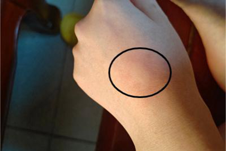 青霉素过敏包块图