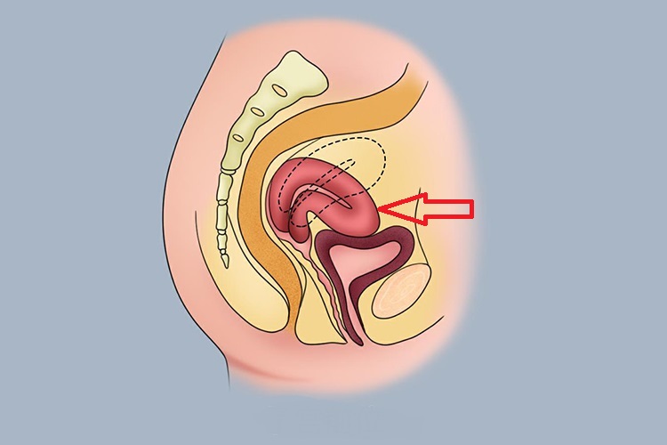 子宫过度前屈前倾图