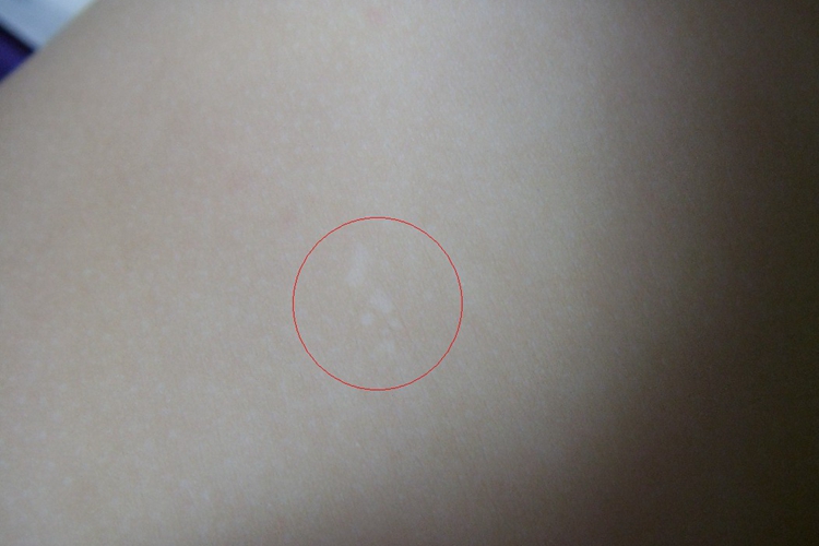 宝宝背部贫血痣图