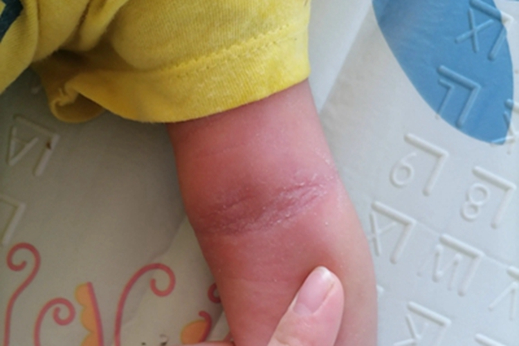 特应性皮炎胳膊脱皮图