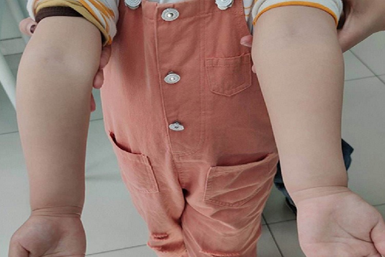 女孩手肘内翻图