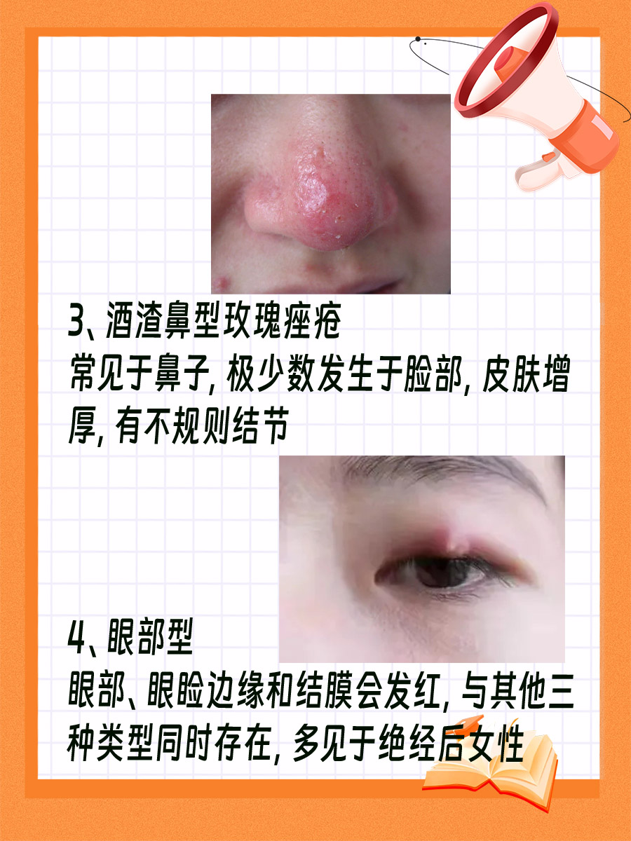 玫瑰痤疮的4种类型，快来看看你是属于哪一种