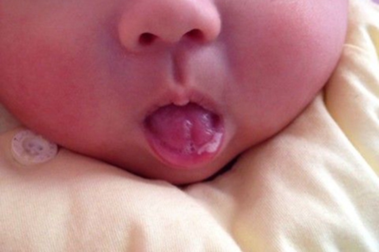 鹅口疮嘴唇内侧白斑图