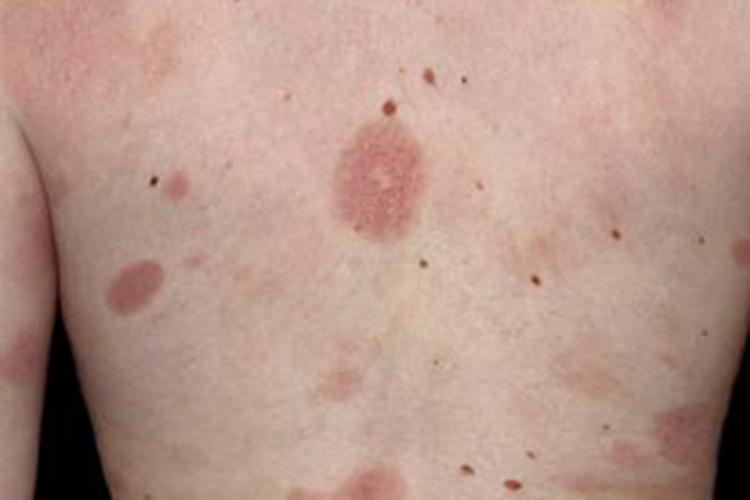 蕈样肉芽肿红斑期非萎缩性斑片图 蕈样肉芽肿红斑期非萎缩性斑片图